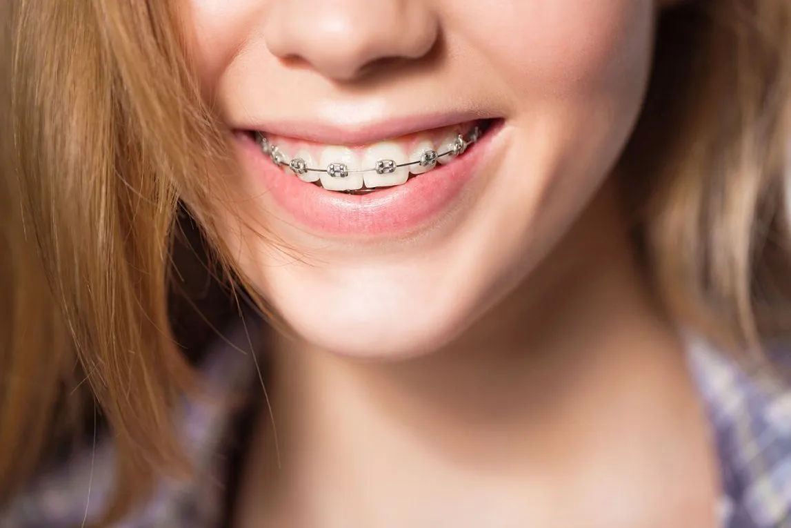 Lợi ích của việc niềng răng