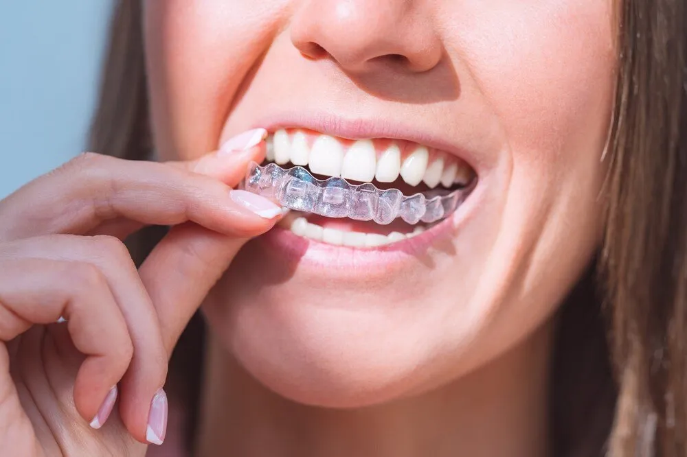 Giá niềng răng trong suốt bao nhiêu tiền