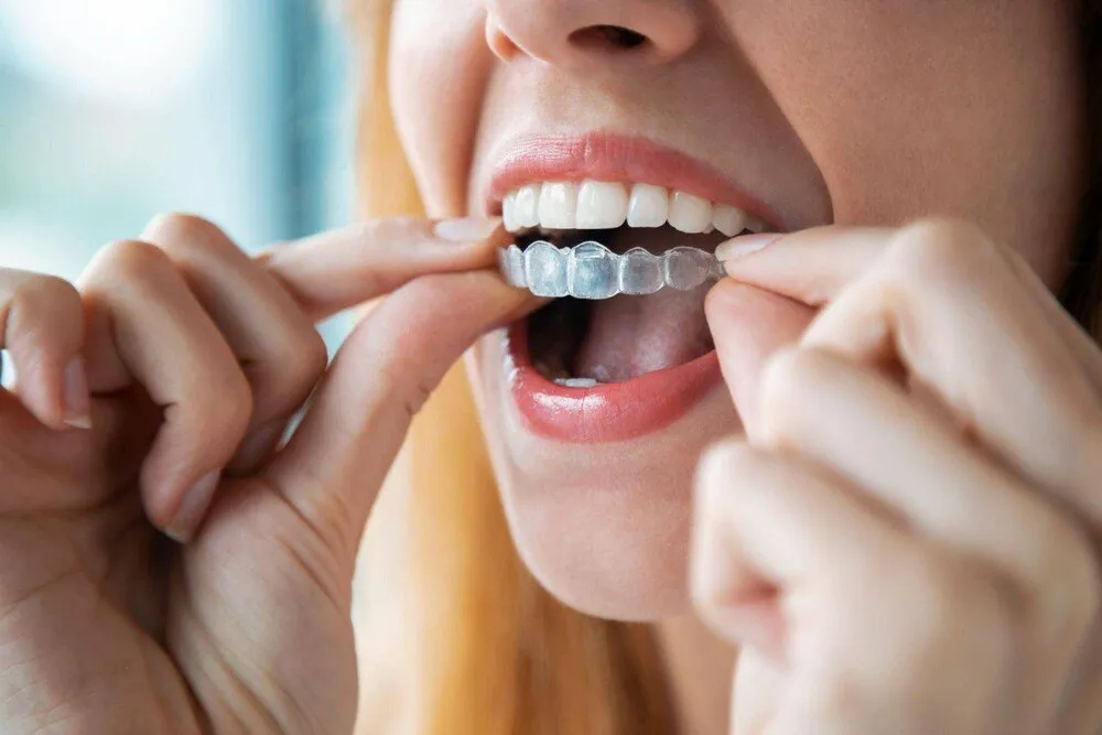 Ưu nhược điểm niềng răng trong suốt