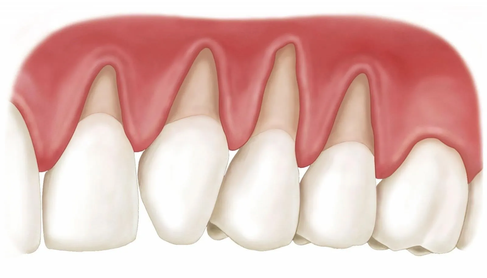 Các mức độ tụt lợi răng lung lay nguy hiểm bạn cần biết - Nha khoa DrGreen
