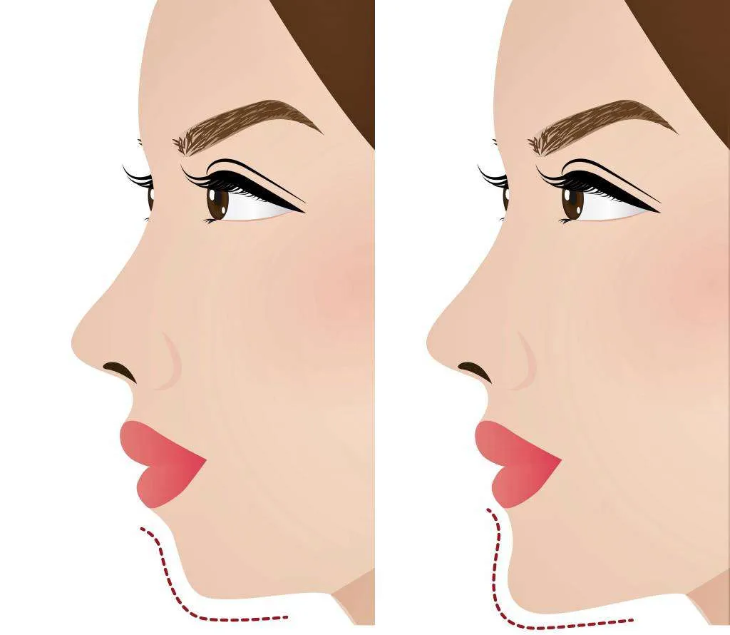 Lợi ích niềng răng 18 tuỏi