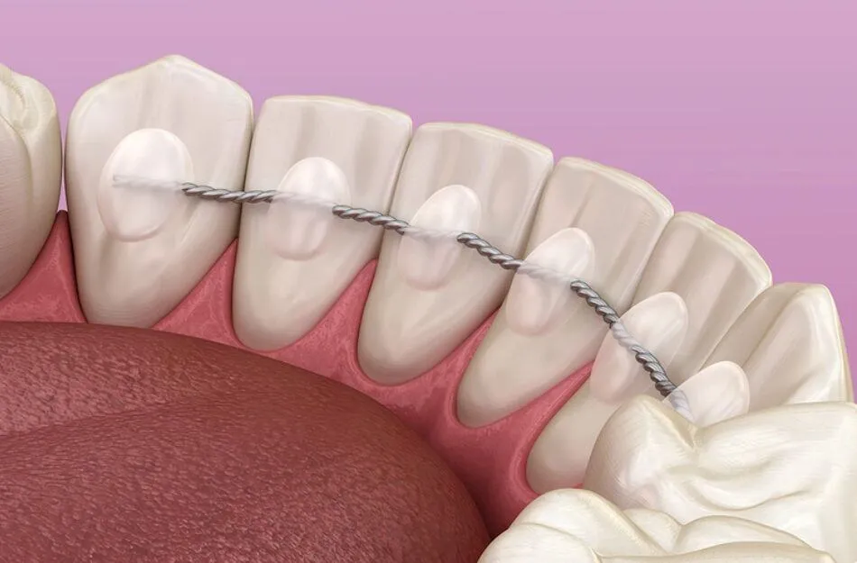 có phải đeo hàm duy trì cả đời không