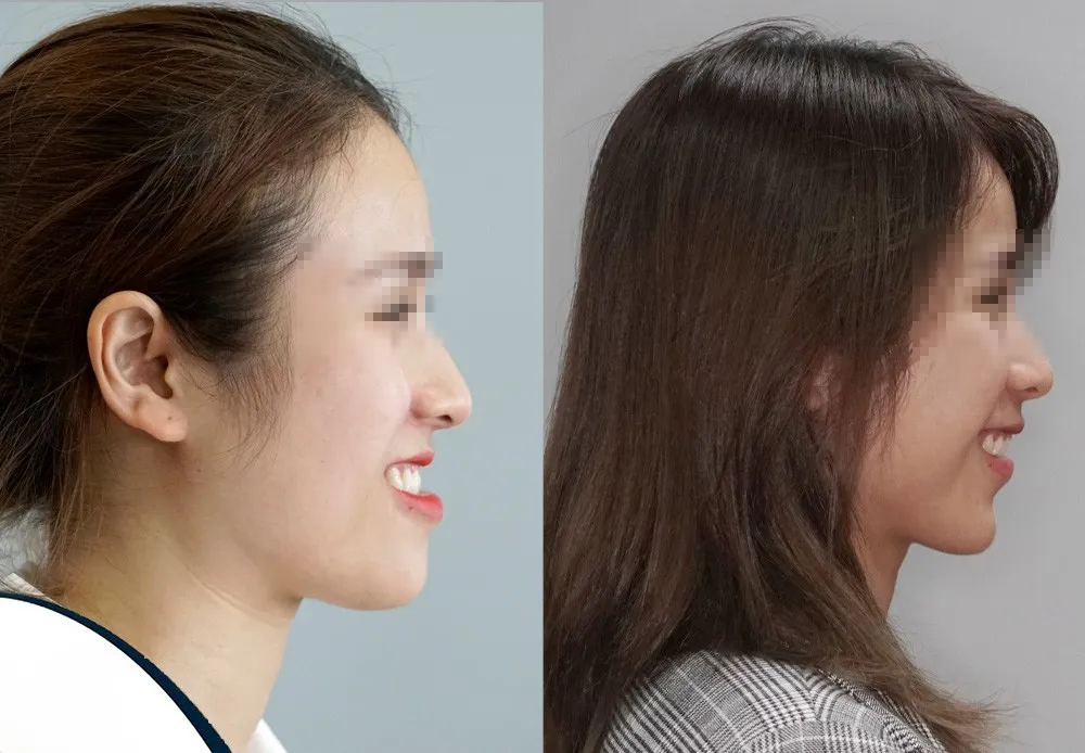 Niềng răng có thay đổi khuôn mặt không