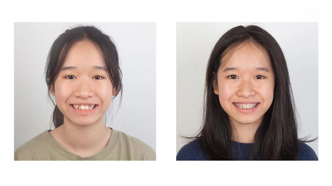 Niềng răng có thay đổi khuôn mặt không