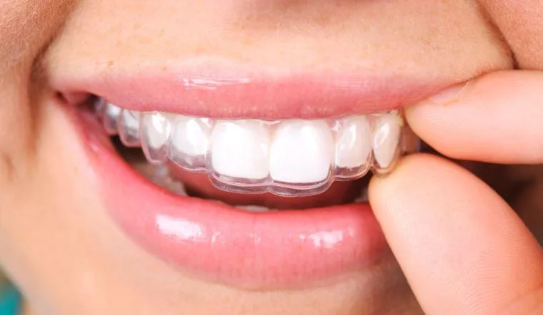 có phải đeo hàm duy trì cả đời không