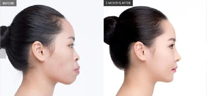 Niềng răng có thay đổi khuôn mặt không