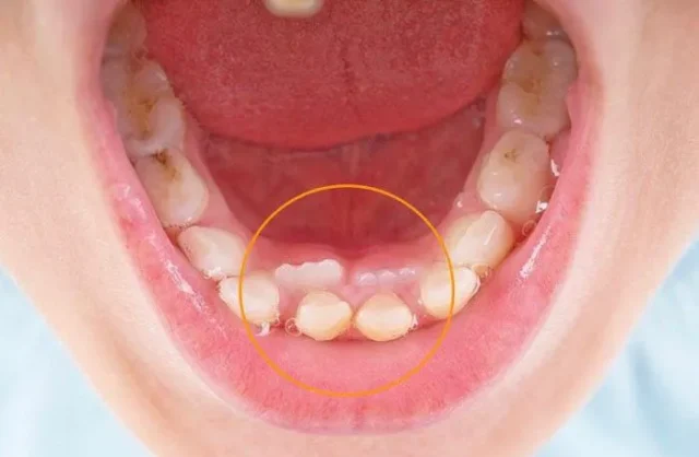 răng mọc lộn xộn