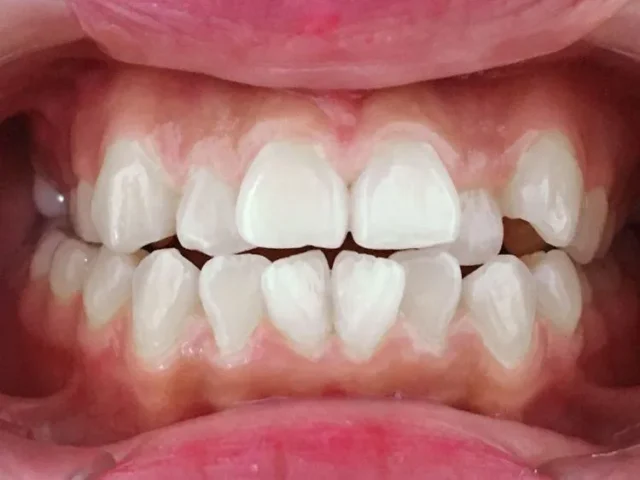 răng lộn xộn có bọc sứ được không