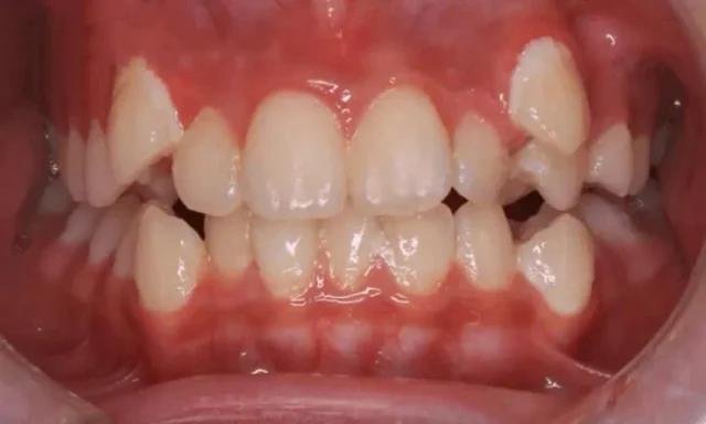 răng khểnh hàm dưới