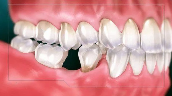 nhổ răng số 7 có bị hóp má không