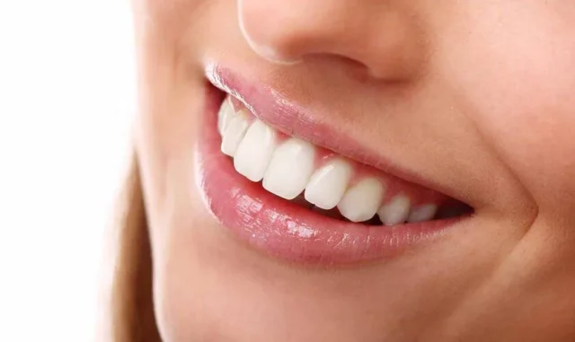 răng mọc lộn xộn