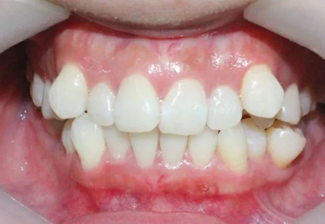 răng lộn xộn có bọc sứ được không