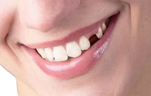 tác hại của việc nhổ răng số 4