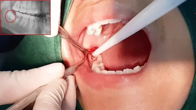 nhổ răng hàm có ảnh hưởng đến thần kinh không