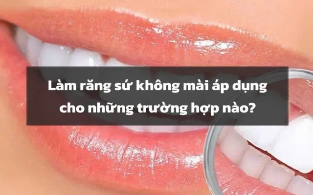 bọc răng sứ không mài
