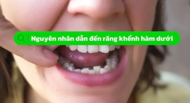 răng khểnh hàm dưới