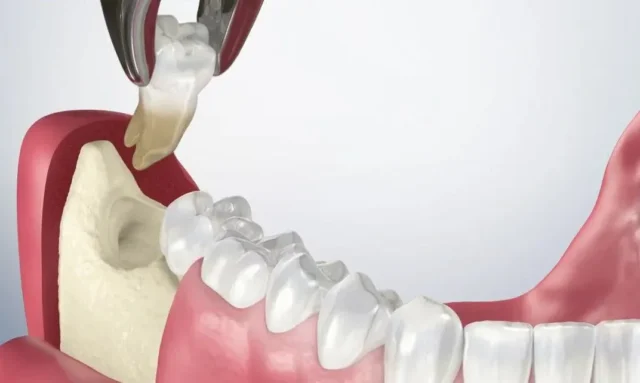 có nên giữ lại răng khôn sau khi nhổ
