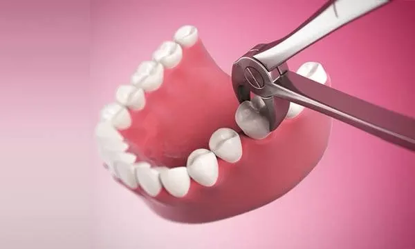 trám răng ở Hải Phòng