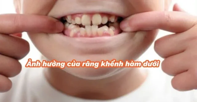 răng khểnh hàm dưới