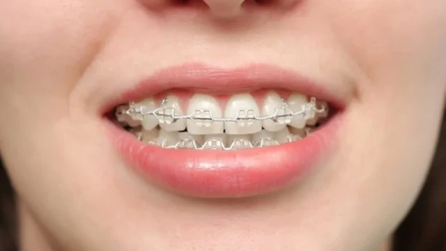 răng mọc lộn xộn