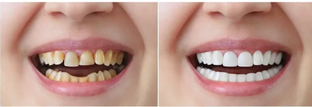 răng lộn xộn có bọc sứ được không