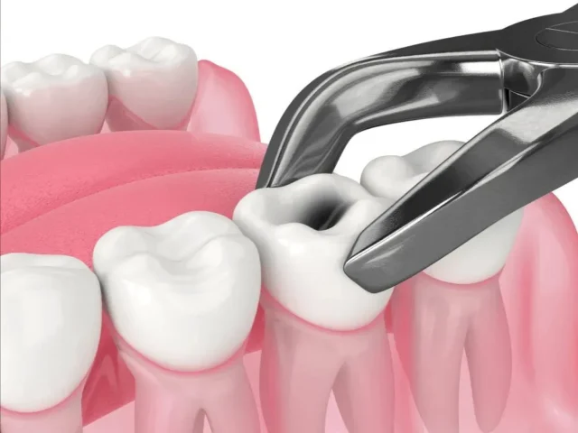 nhổ răng hàm có ảnh hưởng đến thần kinh không
