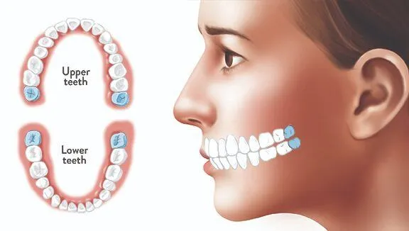 có nên giữ lại răng khôn sau khi nhổ
