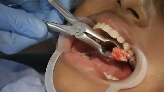 có nên giữ lại răng khôn sau khi nhổ
