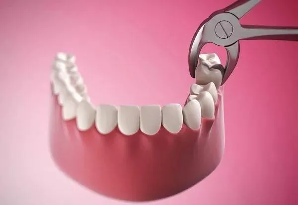 nhổ răng số 7 có bị hóp má không