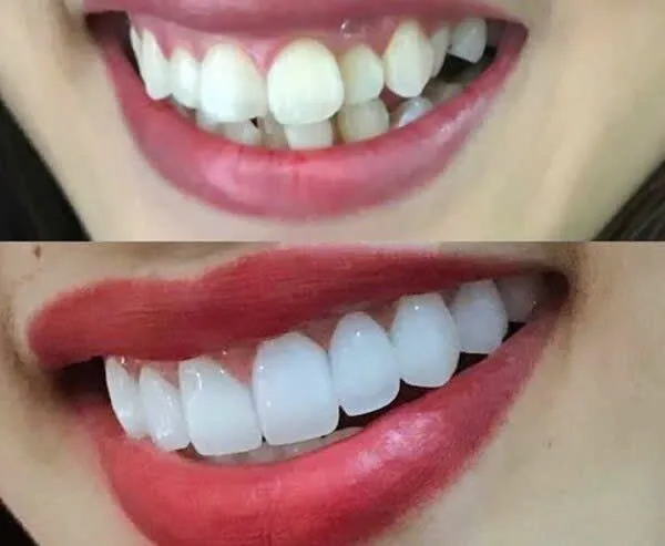 răng khểnh hàm dưới