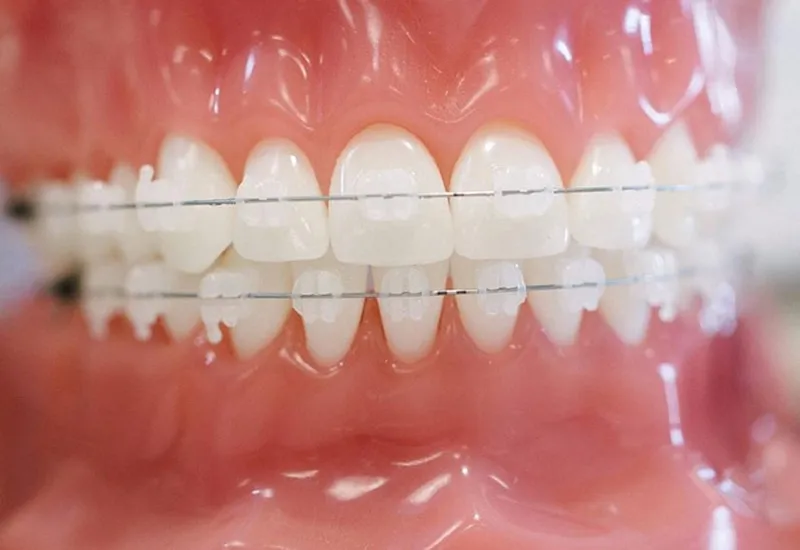 Lợi ích khi niềng răng mắc cài pha lê