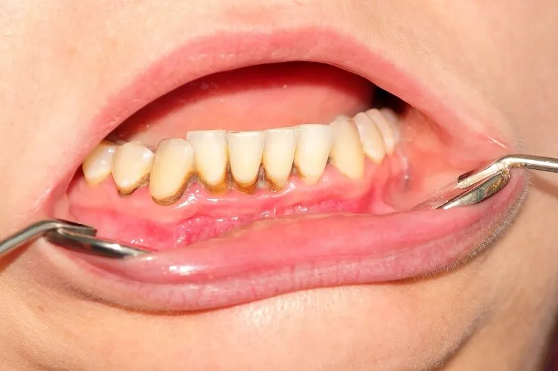 Dịch vụ lấy cao răng điều trị nha chu