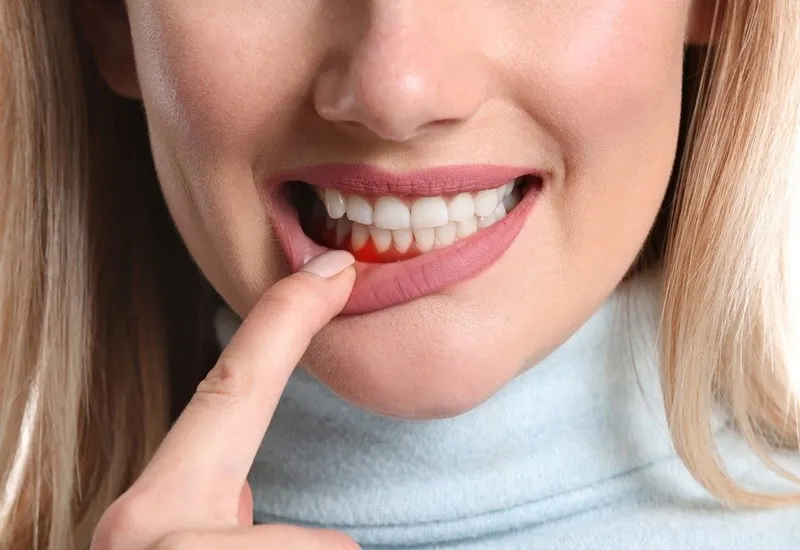 Dịch vụ lấy cao răng điều trị nha chu Hải Phòng uy tín