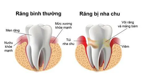 Dịch vụ lấy cao răng