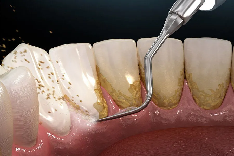 lấy cao răng điều trị nha chu