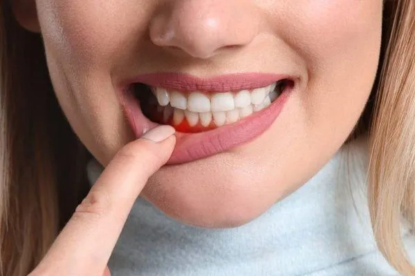 Viêm lợi răng sứ