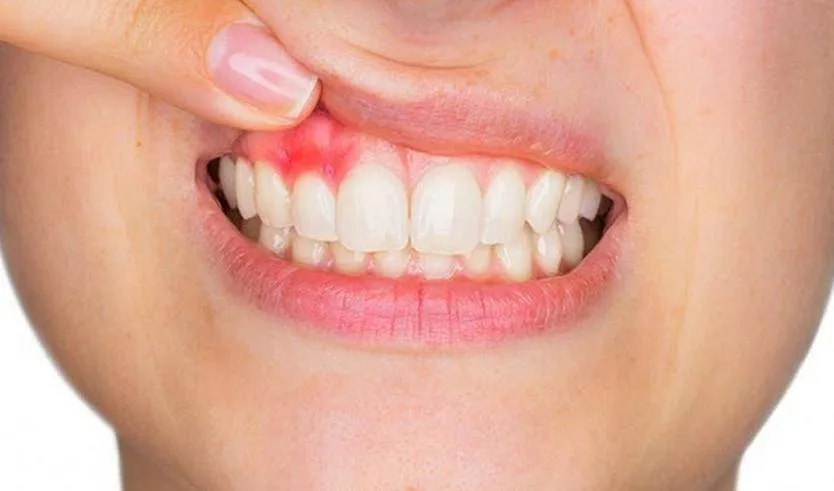 làm răng sứ xong bị viêm lợi