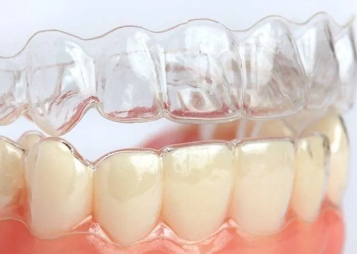 niềng răng 3d clear 6 tháng đến 1 năm