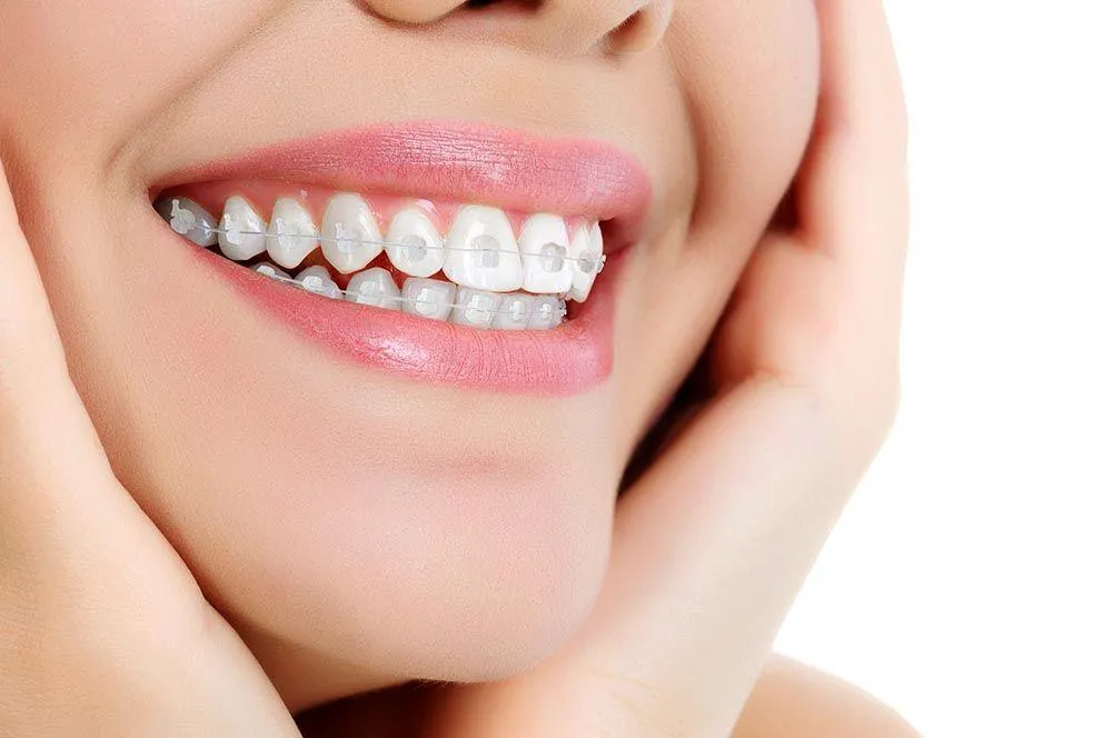 Niềng răng mắc cài pha lê