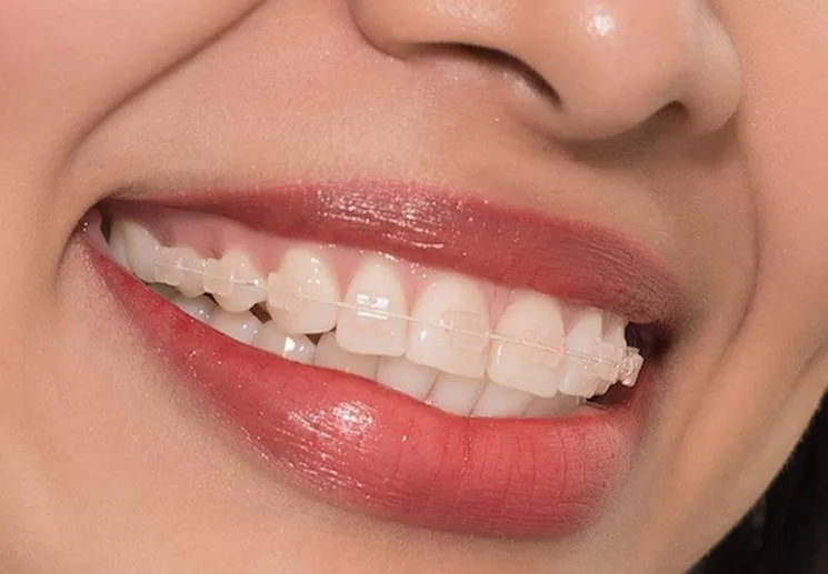 Mắc cài pha lê niềng răng