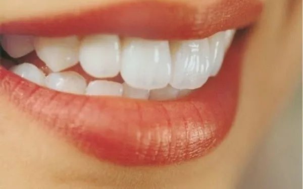 Các kiểu răng hô phổ biến - Hô trên