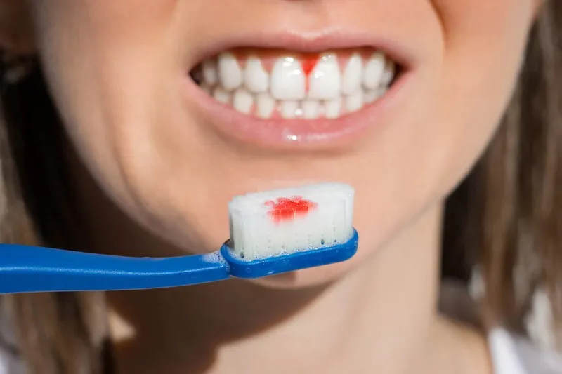 Nguyên nhân lấy cao răng xong bị chảy máu