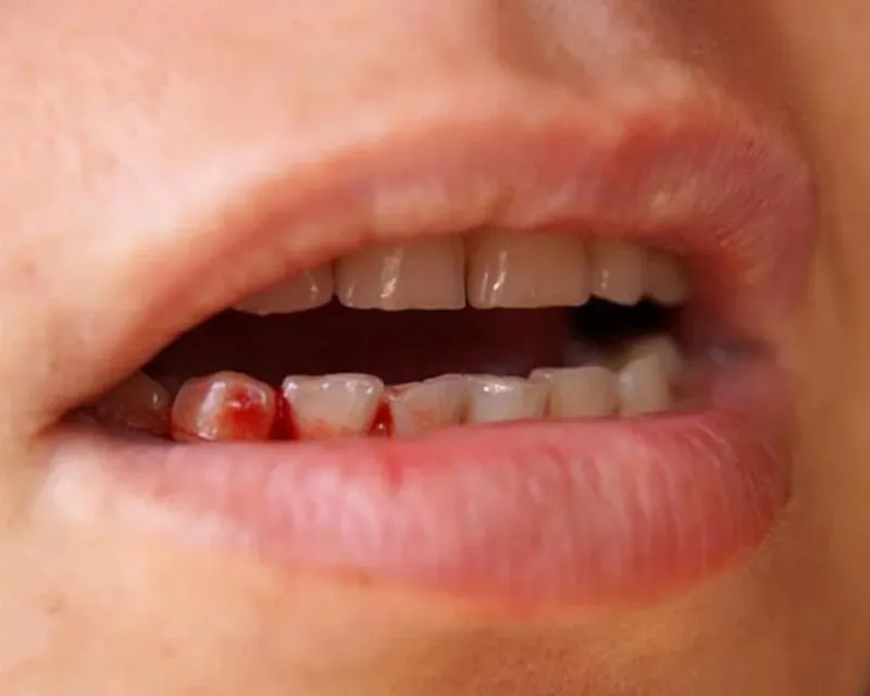 Các cách cấm máu chân răng khi lấy cao răng