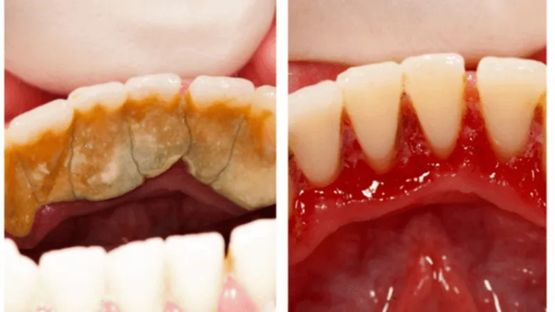 Cao răng bị vỡ có nguy hiểm không