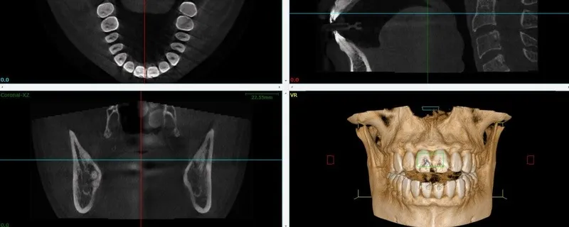 Chụp ct conebeam là gì
