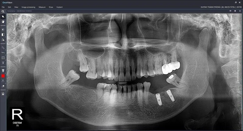Tại sao nên chọn ct conebeam