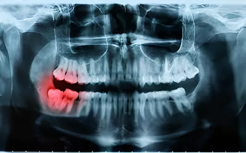 Khi nào nên chụp x-quang răng