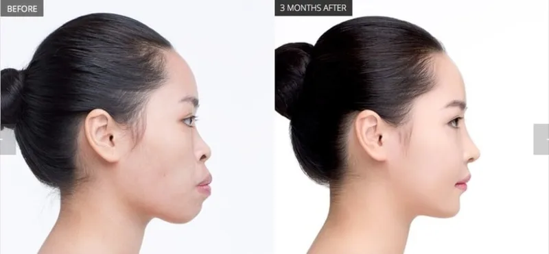 Giải pháp điều trị hô nhẹ và hô nặng