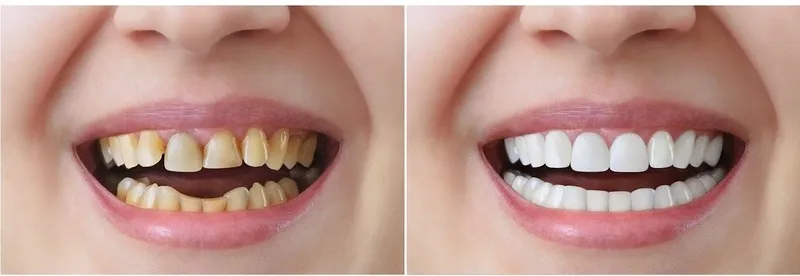 Có nên bọc răng sứ 4 răng cửa không