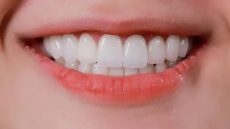 Làm răng sứ 4 răng cửa giá bao nhiêu